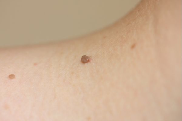 Skin Tag Neck