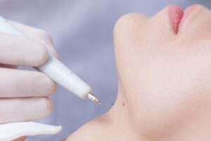 Laser Mole Treatment