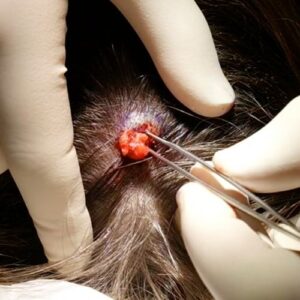 Pilar Cyst Removal
