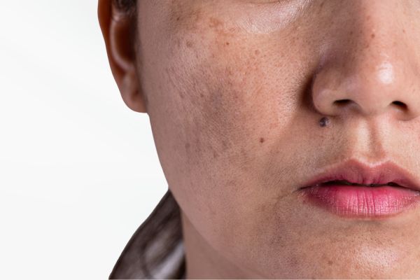 Laser Pigmentation Therapy