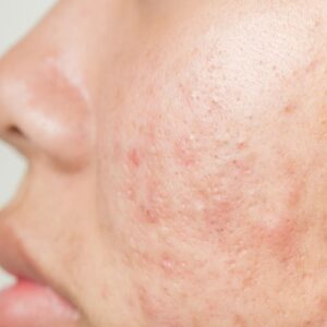 Acne Scarring