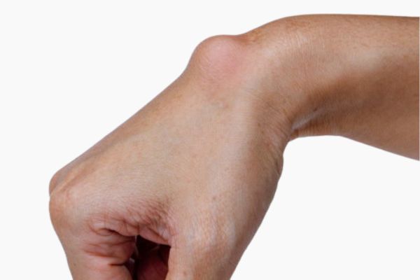 Ganglion Removal