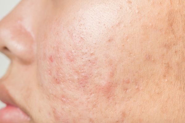 Acne Scarring