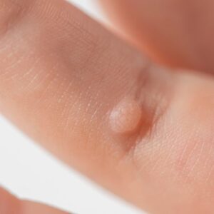 Warts