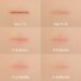 Ellipse Excision - Surgical Mole Removal | Cosmedics Skin Clinics