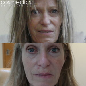 Before after bells palsy botox fillers