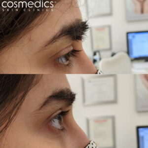 Large Eyebrow Mole Removal Results