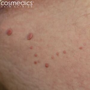 skin tag removal groin