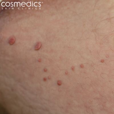 skin tag removal groin