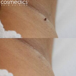 Skin tag removal from the underarm - before and after results