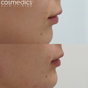 Chin reshaping dermal fillers