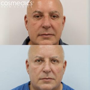 Male upper blepharoplasty results