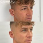 Male Upper Blepharoplasty Eyelid Removal Results Right